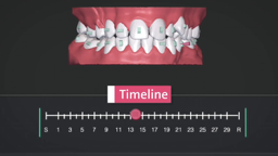 Ortodoncia invisible Dentinela